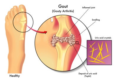 How gout accumulates